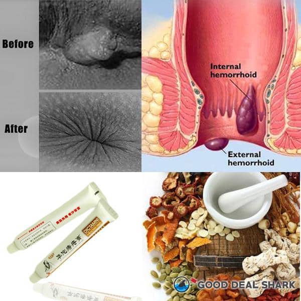 What Herbs Are Good For Hemorrhoids