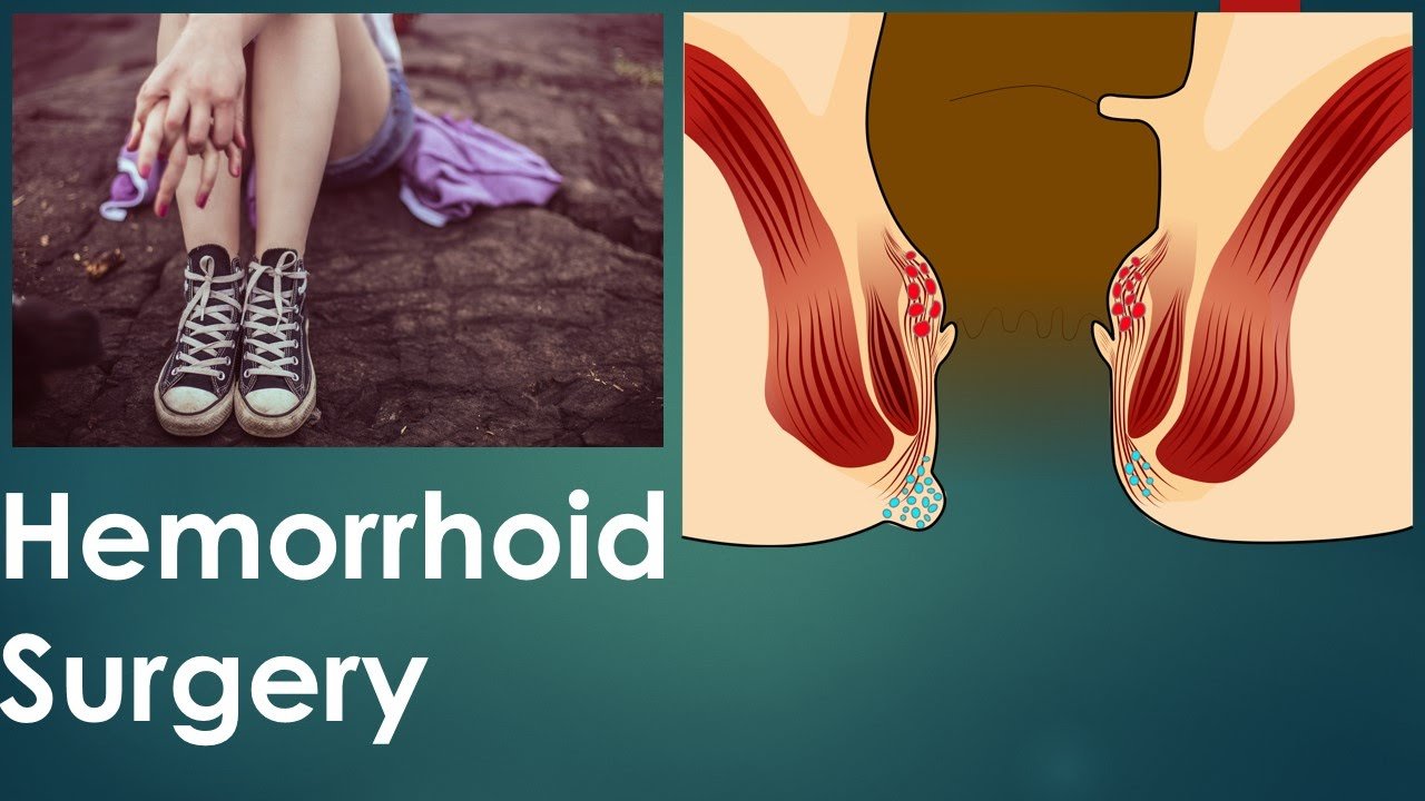 What is a Hemorrhoid? What Is The Cause of Hemorrhoids ...