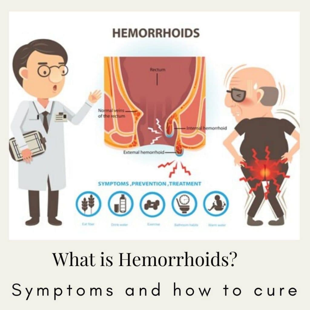 What is hemorrhoids? Symptoms and how to cure (July, 2022)