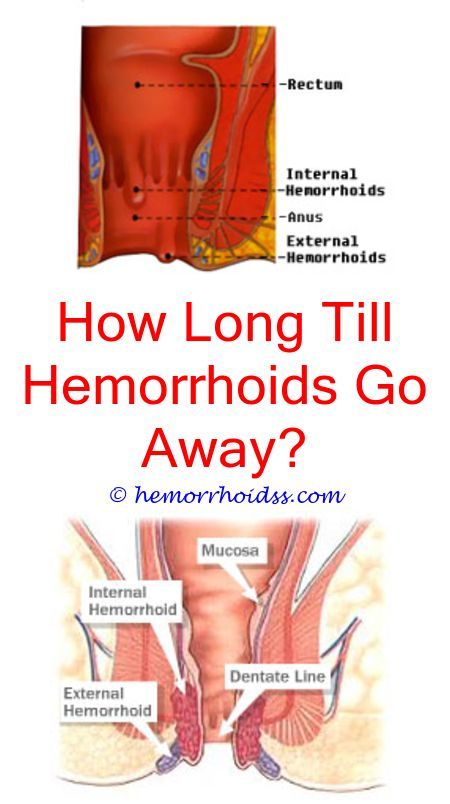 What Is The Best Otc Hemorrhoid Treatment? how heal a ...