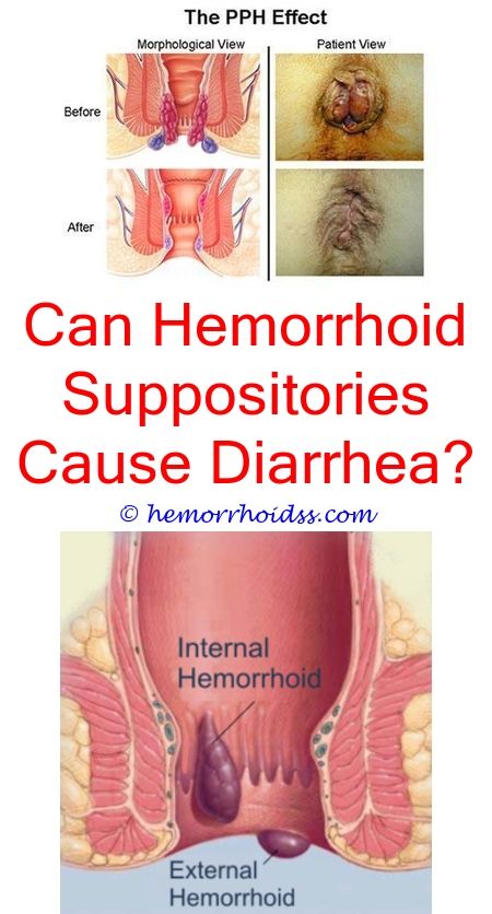 What Is The Most Effective Hemorrhoid Cream? what cream ...