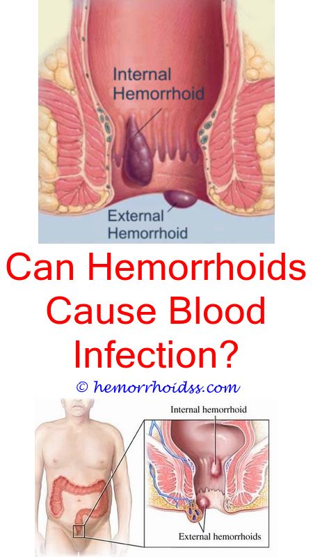 What Kind Of Doctor Do You See For Hemorrhoid Removal