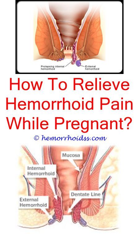 What Kind Of Doctor Should I See For Internal Hemorrhoids