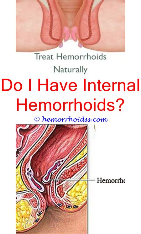 What Medicine Do You Take For Hemorrhoids? can you get rid ...