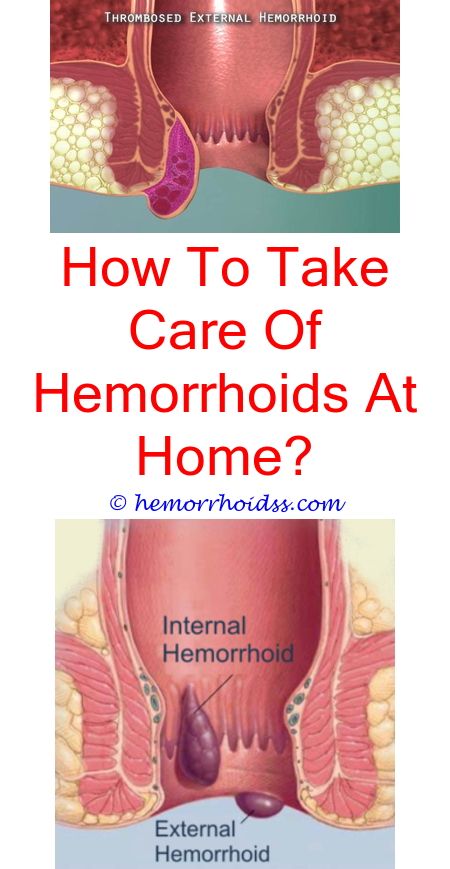 What Should A Hemorrhoid Feel Like