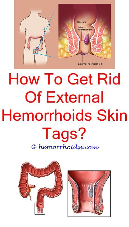 What To Do Against Hemorrhoids? is hemorrhoid cream safe ...