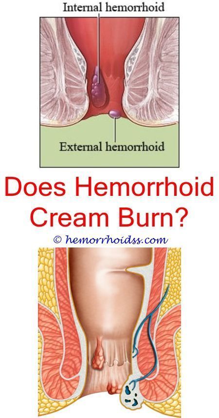 What Type Of Doctor Do You See To Remove Hemorrhoids