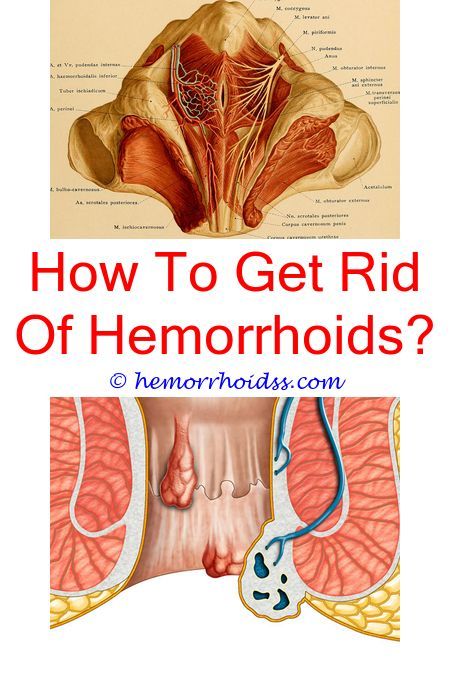 What You Should Know About Your Hemorrhoids (With images)