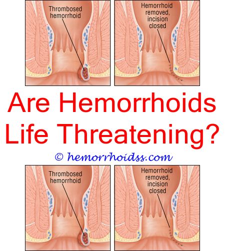 When Do Internal Hemorrhoids Need Surgery? what to do for a hemorrhoid ...