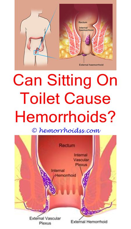 When Should I See A Doctor For Rectal Hemorrhoids ...