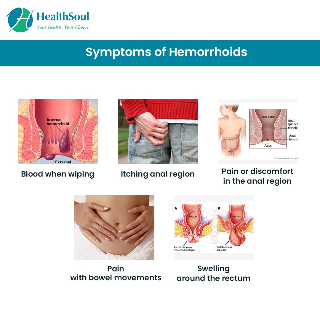 When To See Doctor Hemorrhoids