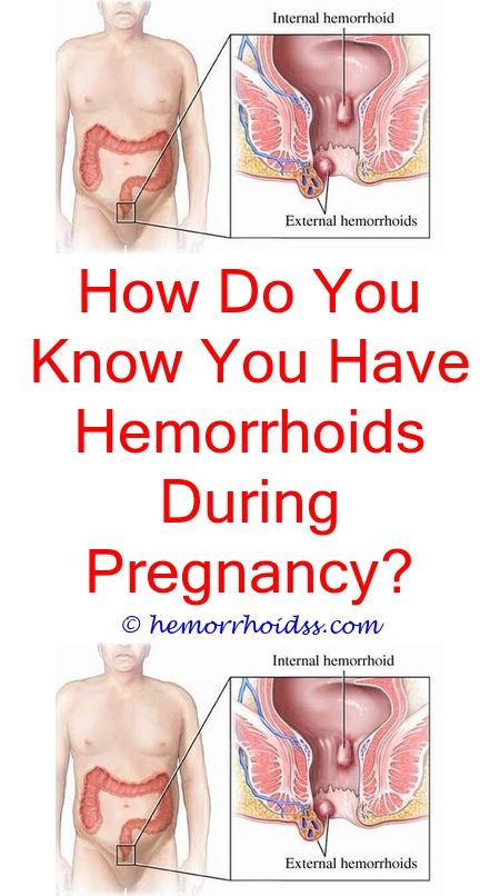 When You Have Hemorrhoid Banding When Will It Fall Out ...