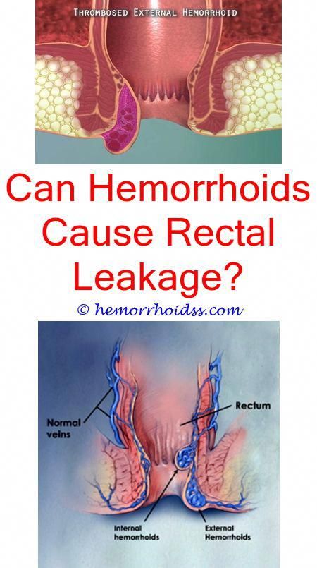 Where Does Blood Go When Hemorrhoid Shrinks? how to pass a bowel ...
