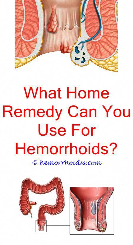 Who Removes External Hemorrhoids? do hemorrhoids itch when ...