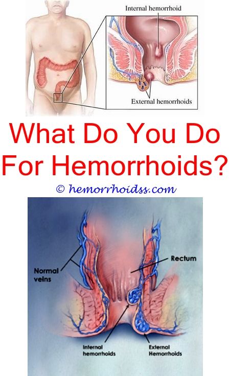 Who Removes External Hemorrhoids?