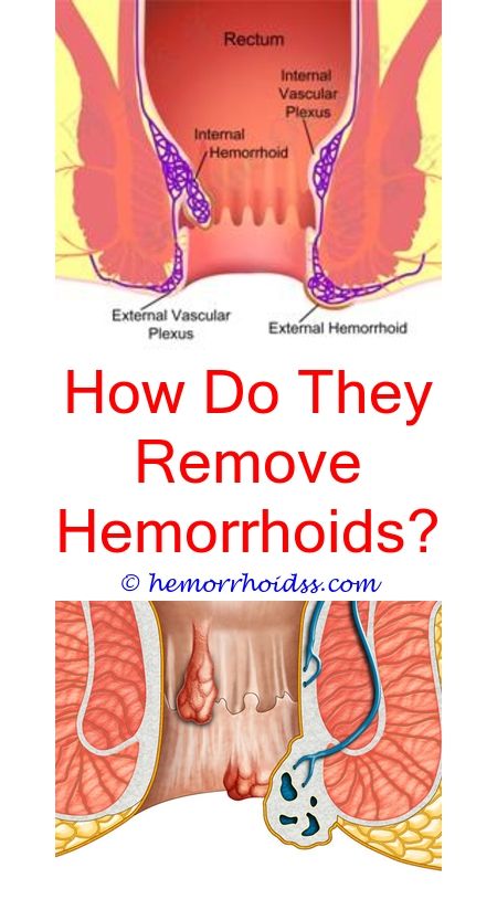 Why are my hemorrhoids so itchy?.Is colonic irrigation ...