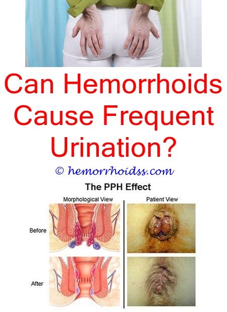 Will A Thrombosed Hemorrhoid Go Away On Its Own ...