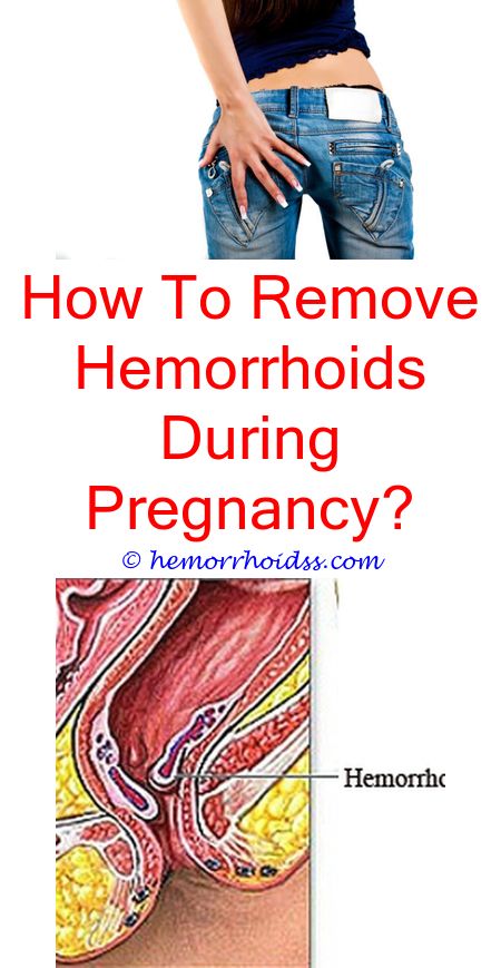 Will Hemorrhoids Go Away?